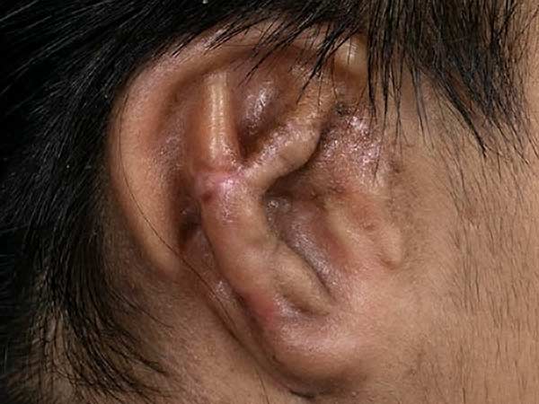 Ear Reconstruction