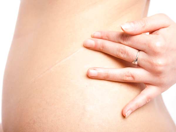 Scar Revision