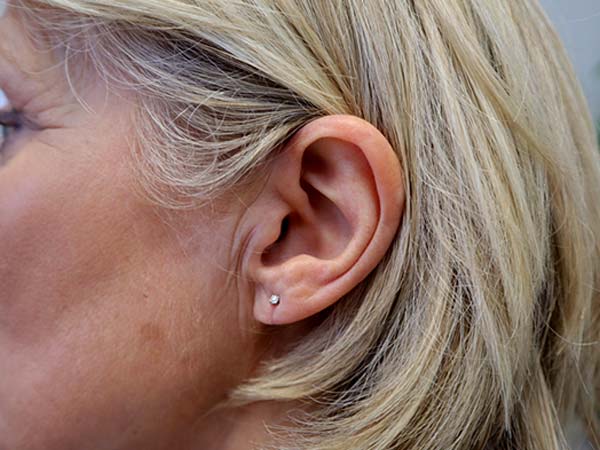Split earlobe repair after