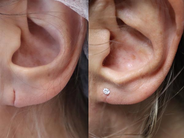 Split earlobe repair, before & after