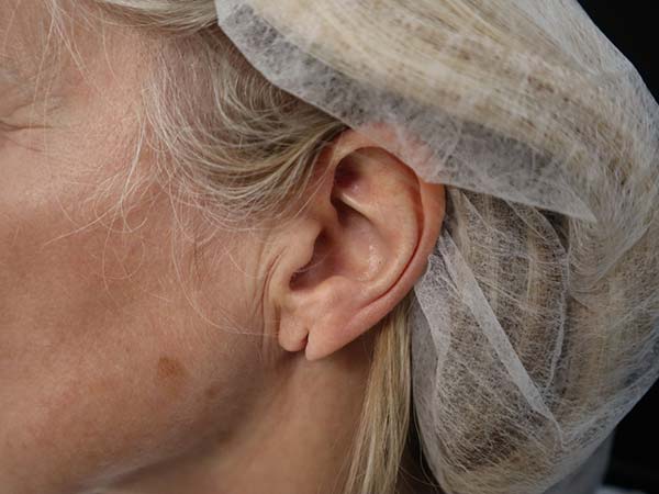 Split earlobe repair before surgery