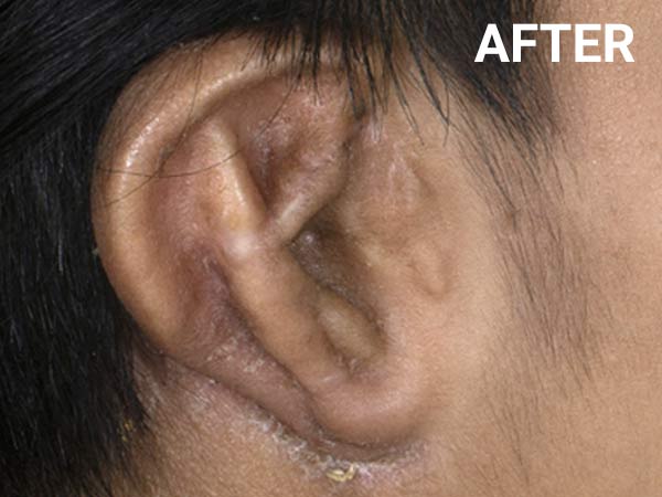 Ear reconstruction after