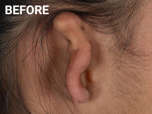 Ear reconstruction before