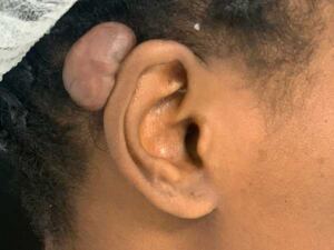 Ear Keloid Removal